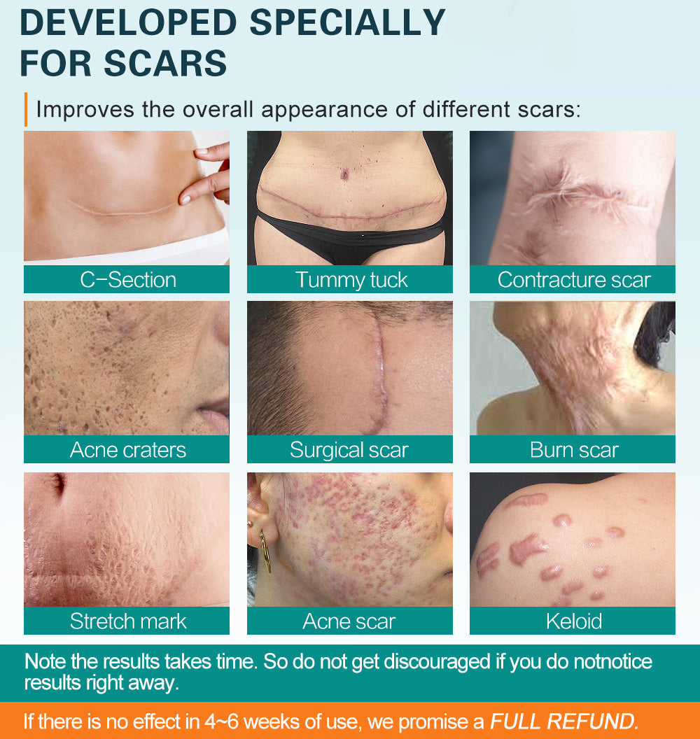 Sounth Moon ™ Advanced Scar Spray minden típusú heghez - például pattanások, sebészeti hegek és striák