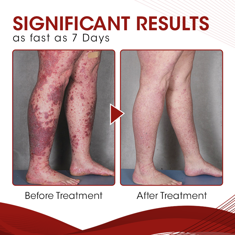 Pulvérisation de traitement au psoriasis